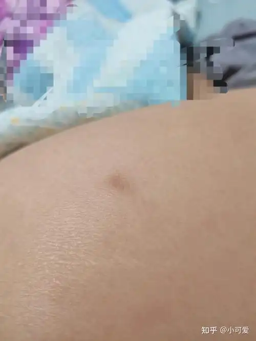 大腿上长了一个硬硬的小疙瘩暗暗的不痒不痛如图已经很长时间了感觉很