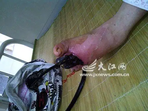 患者截肢前的病脚.