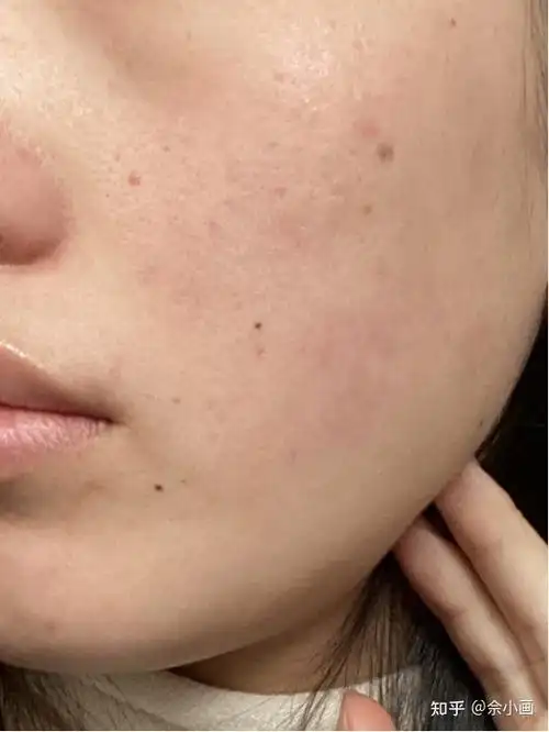 角质层薄怎么办乱用护肤品导致角质层变薄怎么修复