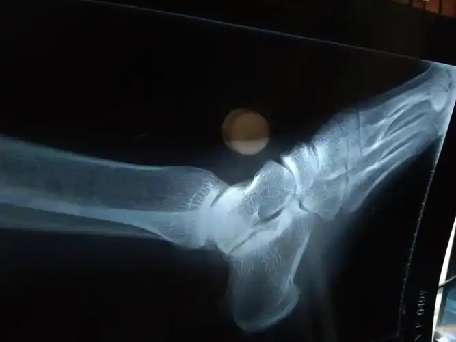 脚撕脱骨折,没固定,一个多月了还是肿痛,分别拍了片子,现在的片子愈合