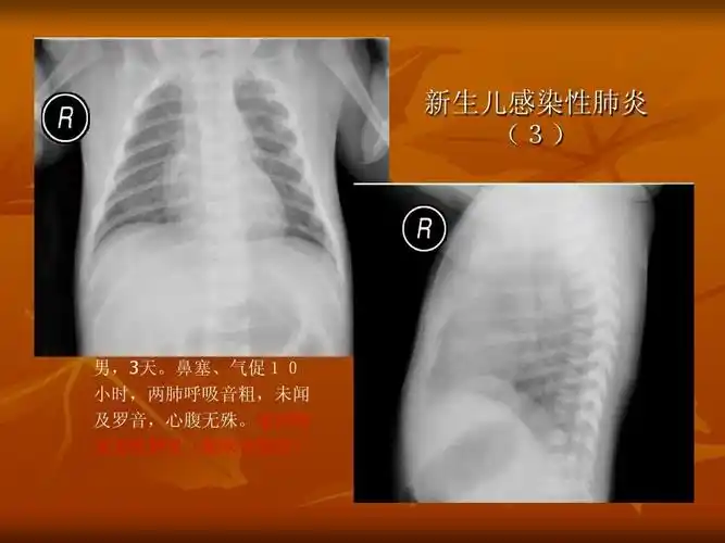 新生儿肺部常见疾病的x线诊断2 新生儿感染性肺炎     男,3天.