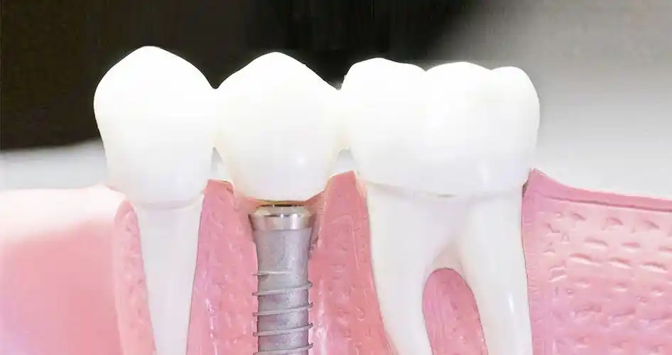 牙齿种植只有老年人才需要做吗?