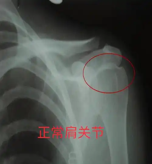 患侧上肢向下脱垂,使得韧带松弛上部从关节处下滑,出现肩关节半脱位.