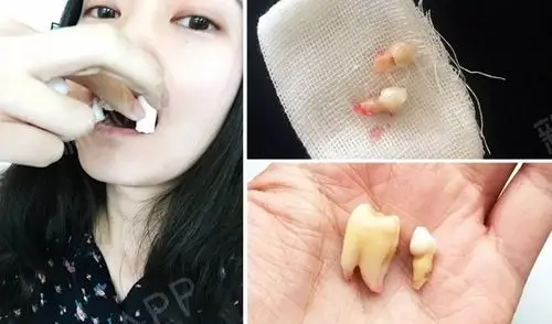 一直被两颗长歪的虎牙困扰