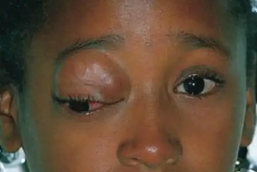 眼眶横纹肌肉瘤