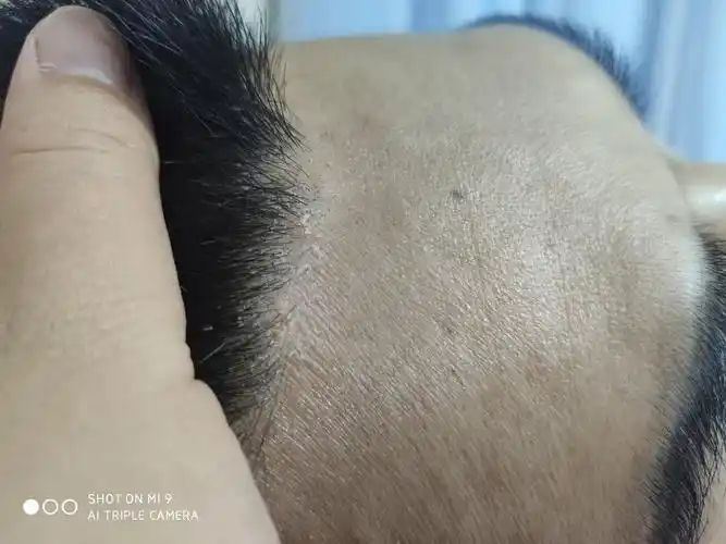 头皮出现这种情况,是脂溢性头皮炎还是头皮癣?