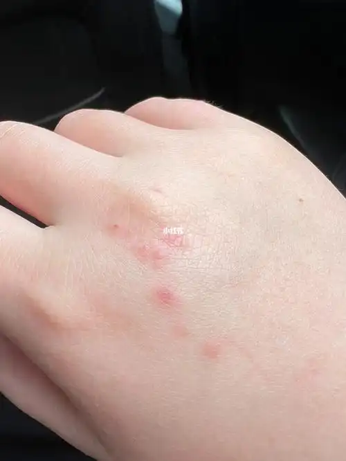 有和我一样手背一晒太阳就过敏的吗0909