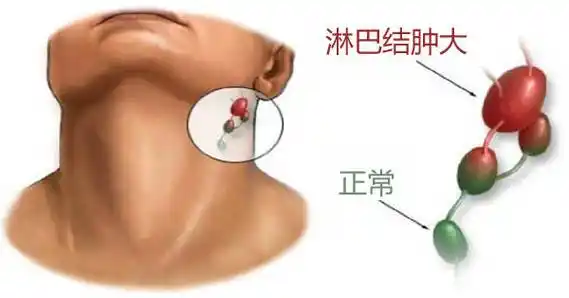 淋巴结肿大不要掉以轻心,有可能是恶性淋巴瘤_检查_医生_进行