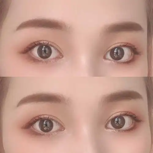 双眼皮多宽算自然?宽度怎么衡量?