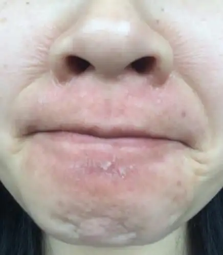 这个是脂溢性皮炎吗,怎么办呀,发红,起皮屑,时而痒,皮肤发皱紧绷,而且