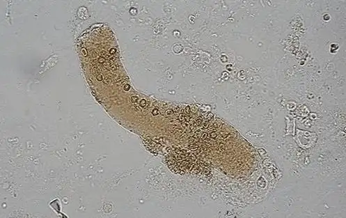 血红蛋白管型,新鲜尿未染色,放大倍数 400 倍,管型内残存少许红细胞