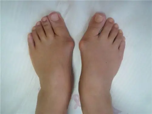 拇外翻患者x光图片_有来医生