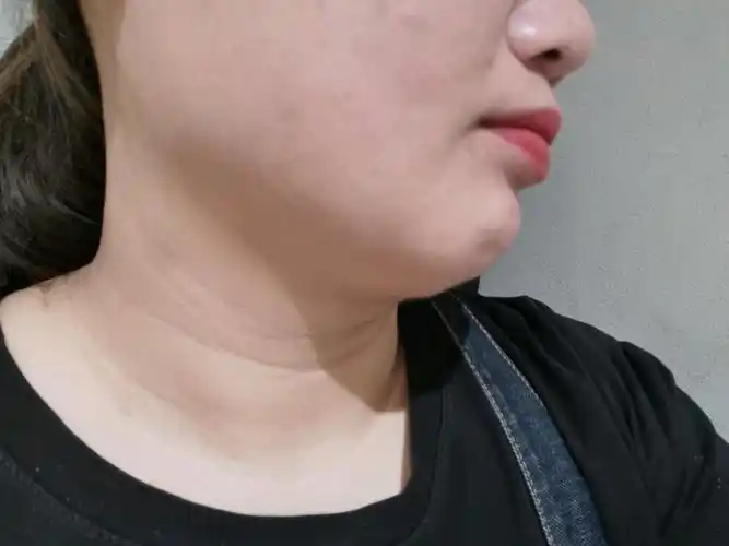 没效果,一个多月了,下巴那里一坨肉凸出的特别明显,_圈子-新氧美容