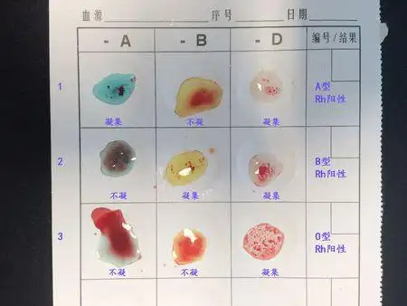 在鉴定人的血型时,一般是用特异性的人抗血清进行凝集反应.