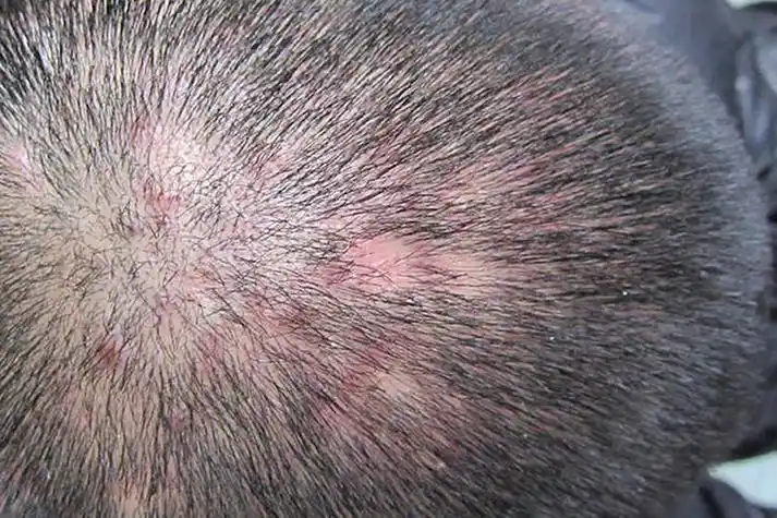 毛囊炎好发于头面部, 皮损初起为红色毛囊性丘疹,即疙瘩,数量不一,数