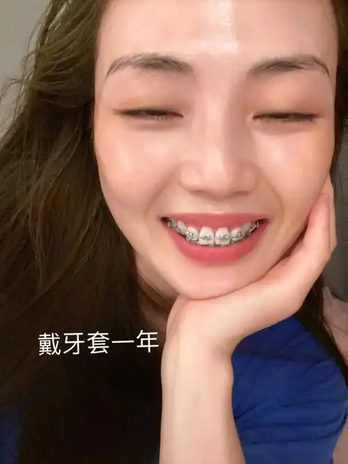 戴牙套整一年