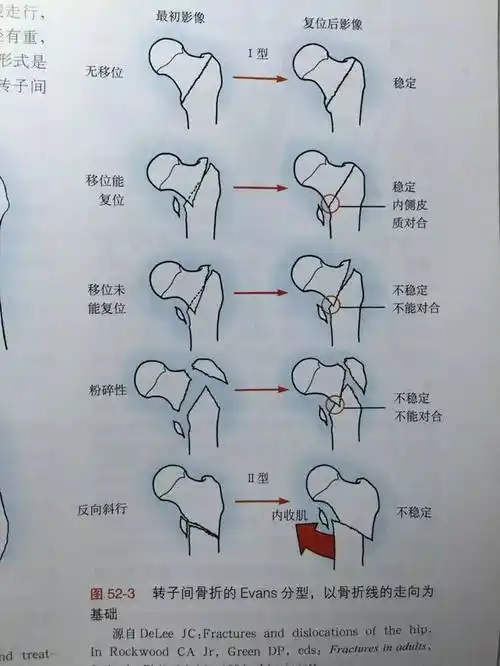 股骨转子间骨折 evans 分型到底应该怎么分
