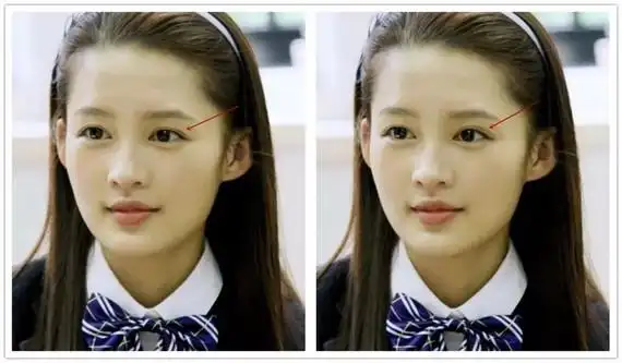 李沁岁数还很小,症状也是最轻的,双眼皮很深,长度稍微偏长.