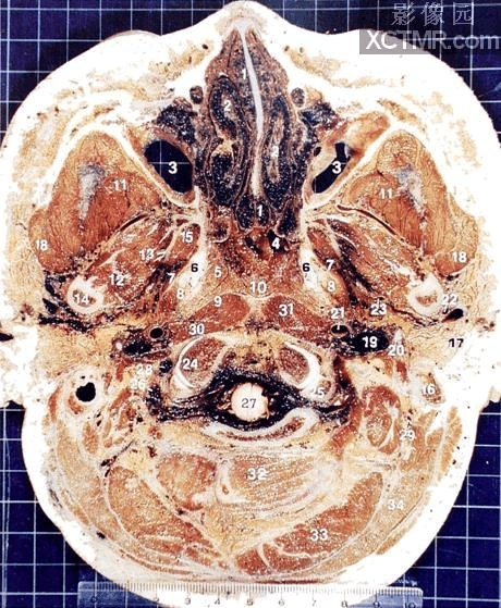 头颅横切面断层解剖