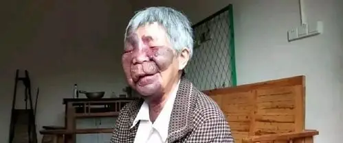 南充农村68岁老人满脸长满血管瘤,眼睛也瞎了40年,可怜!
