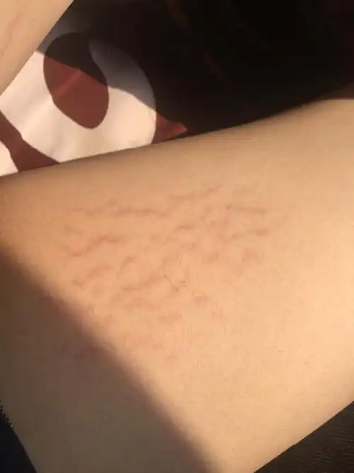 大腿内侧有这样的红色条斑?不疼不痒,是不是性病?还是湿疹?尚未发