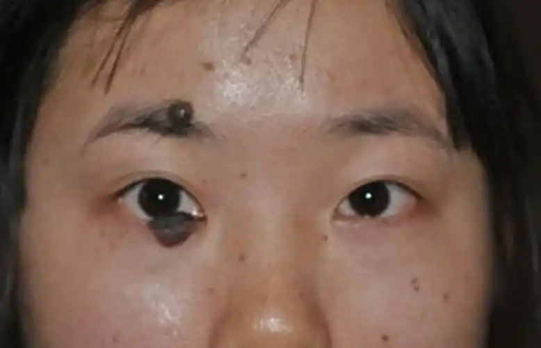 眼睑色素痣