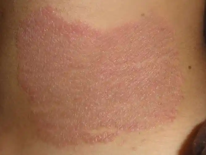 神经性皮炎是什么引起的_皮炎_泉州广肤皮肤病专科_泉州皮肤科哪个