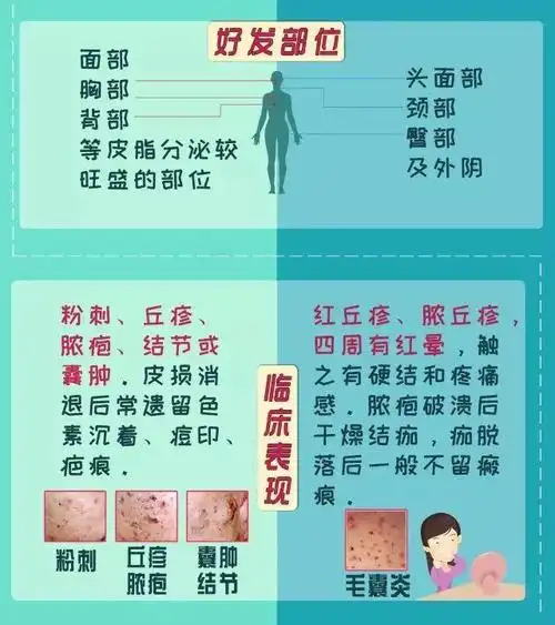 痤疮vs 毛囊炎,它们根本不是一回事!