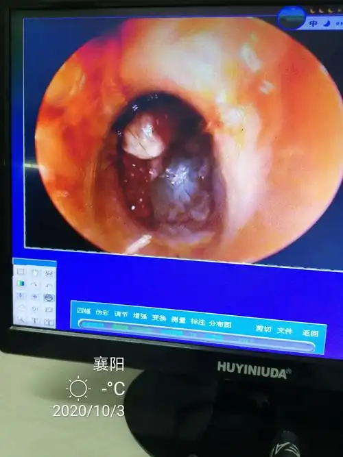 5岁男孩,耳朵长肿瘤! - 好大夫在线