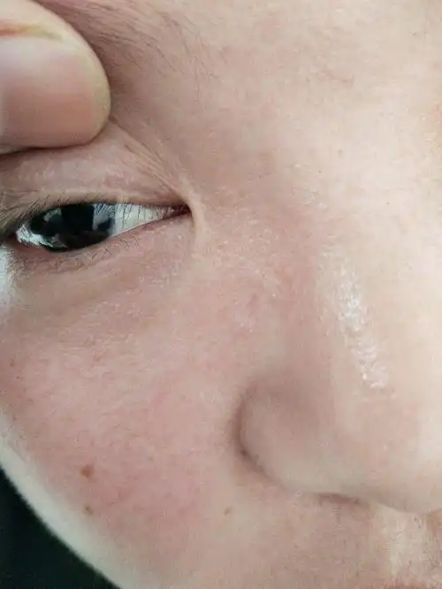 求助上眼皮长的这个颗粒是什么不痛不痒很多年的有没有去除的方法