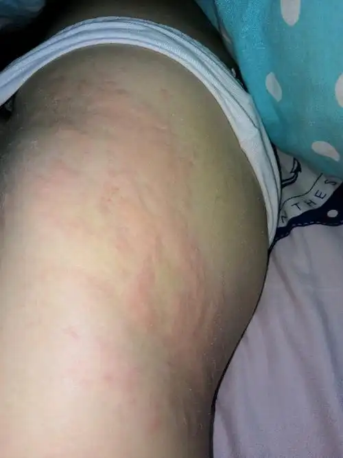 得了妊娠痒疹求止痒方法