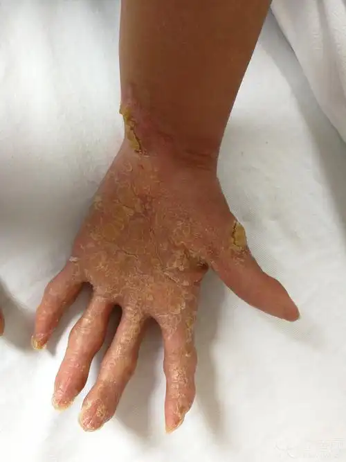 皮肤与性传播疾病讨论版