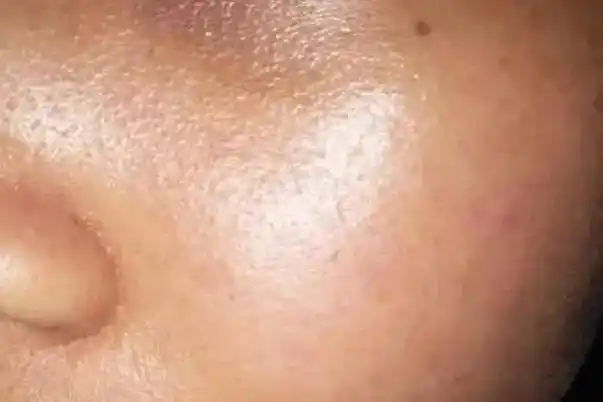 皮肤出油多是什么原因 皮肤出油严重毛孔粗大如何改善