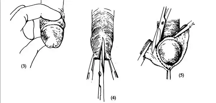 包皮环切一站式全过程详解 - 好大夫在线