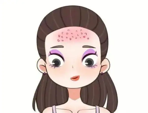 为什么额头总长闭口粉刺?教你如何轻松解决