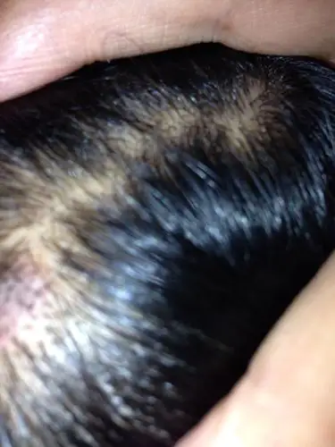 2013-11-03 李龙 医师 头皮长疙瘩,6年了,说是毛囊炎,挠下的死皮中间