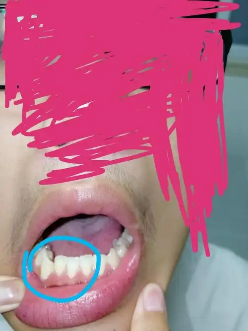 我这个牙齿长歪了怎么办,要去矫正吗,现在准高三