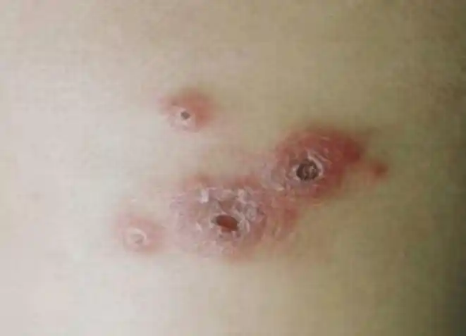 毛囊炎样皮疹左右滑动查看更多图片针扎后出现硬结等不明原因多个系统