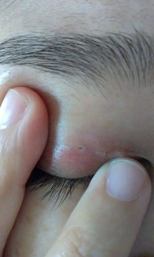 埋线双眼皮结节图片