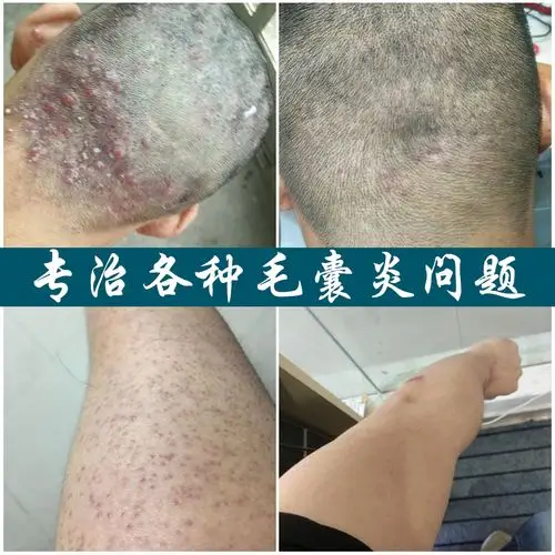 治疗毛囊炎药膏前胸后背部毛囊炎神器去头皮痤疮脓包疙瘩皮肤止痒