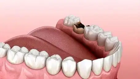 牙齿缺失怎么办?如何修复