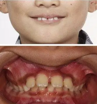 孩子的龅牙一定要等到换完牙再开始矫正吗
