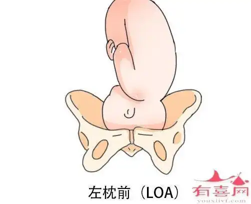 胎位loa是什么意思
