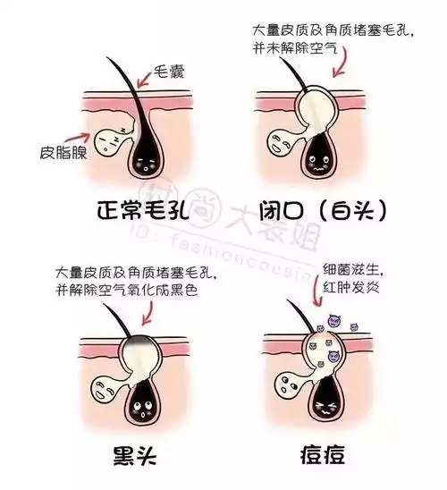 做对这件事很关键_痘痘