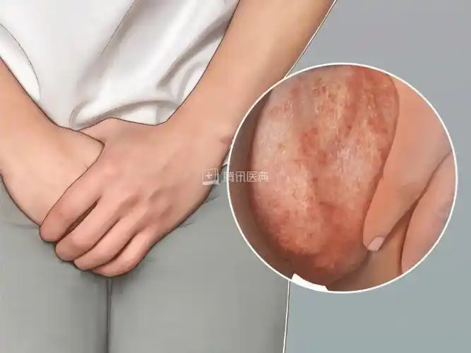 男人的难言之隐阴囊湿疹绣球风如何治疗