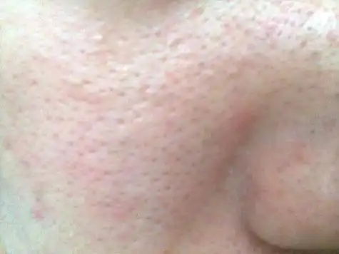 8个妙招教你"对付"毛孔堵塞