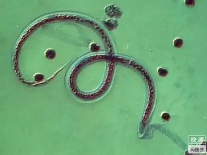 儿童常见肠道寄生虫病——蛲虫病