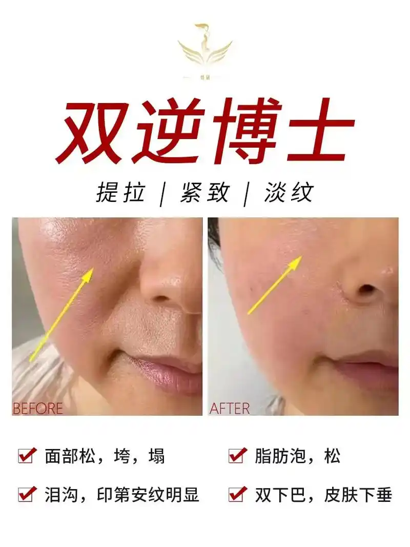 双逆博士一次效果对比90图[强] 从皮肤筋膜层改善肌肤松 垂 - 抖音