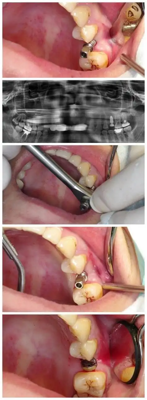 种植牙步骤种植牙步骤先介绍下本人,张永刚:口腔主治医师,同济大学