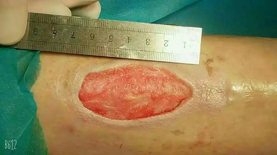 难愈性皮肤溃疡,糖尿病足坏死一站式治疗.(医学专科资料胆小勿视) -